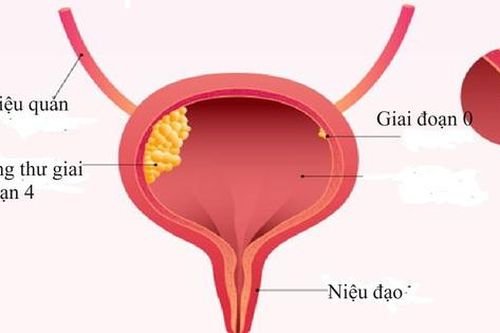 Điều trị ung thư bàng quang