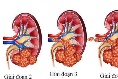 Các lựa chọn điều trị ung thư thận