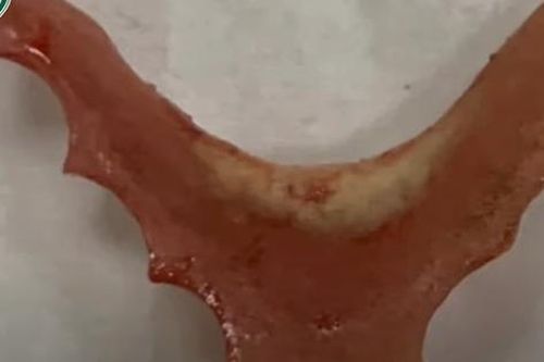 Hóc dị vật thực quản do nuốt răng giả
