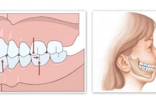Niềng răng mắc cài kim loại giúp khắc phục tình trạng hàm hô, vẩu
