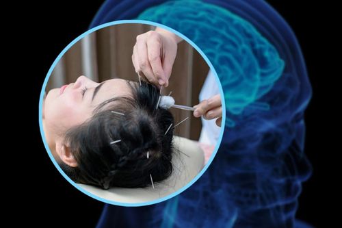 Thực hư phương pháp châm cứu kích thích não bộ để tăng IQ