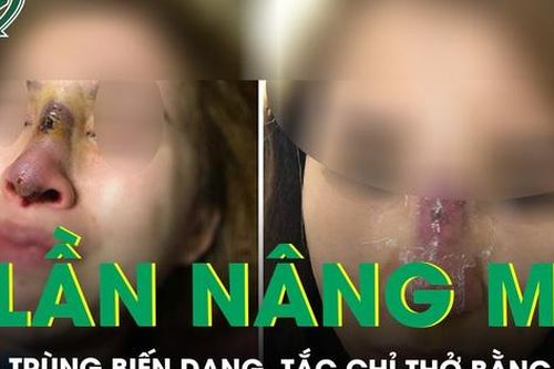 Biến chứng sau 7 lần nâng mũi, bít tắc hoàn toàn chỉ thở được bằng đường miệng