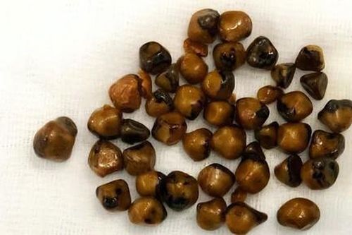 Hơn 40 viên sỏi trong túi mật của nữ bệnh nhân