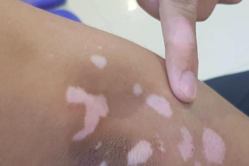 Cầu cứu bác sĩ sau khi mất tiền vì tin quảng cáo 'chữa dứt điểm ngay bạch biến'