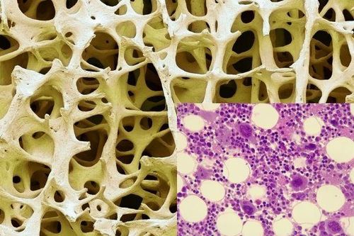 Cần làm gì để phát hiện suy tủy xương?
