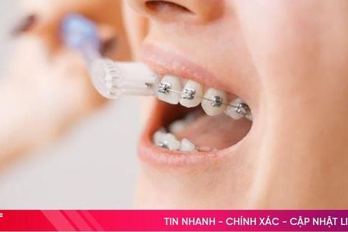Niềng răng mắc cài kim loại và những điều bạn cần biết