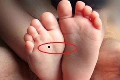 Có phải nốt ruồi ở lòng bàn là phúc tướng, tiền tiêu khỏi nghĩ?