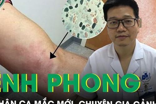 Ghi nhận trường hợp mắc bệnh phong tại Hải Dương, chuyên gia cảnh báo