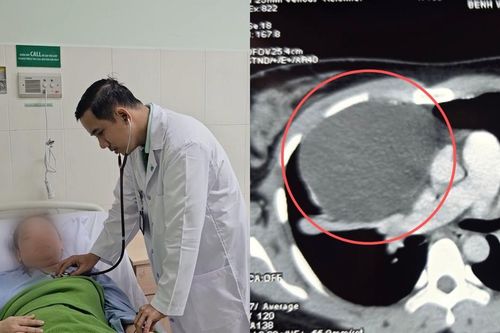 Nội soi lấy khối u 'khủng' chèn ép tim phổi người phụ nữ ở miền Tây