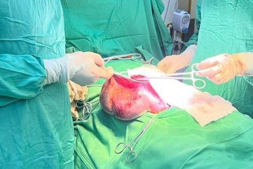 Bé gái 15 tuổi có khối u buồng trứng ác tính, dấu hiệu nào giúp cha mẹ nhận biết?