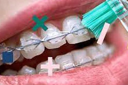 Niềng răng vệ sinh thế nào cho đúng cách?
