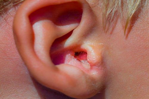 Biểu hiện viêm tai ngoài và cách phòng tránh