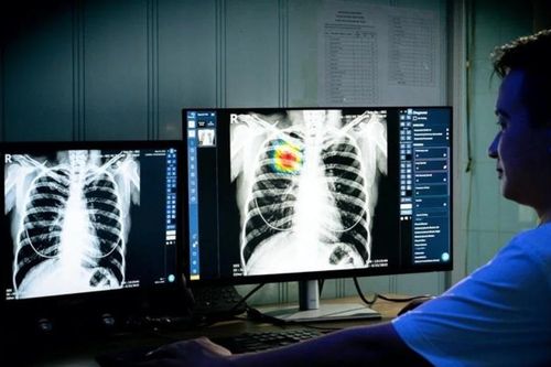 VinBrain hợp tác với Bệnh viện Phổi Trung ương triển khai phần mềm AI trong sàng lọc lao