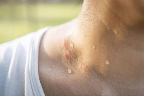 Đổ mồ hôi nhiều cần làm gì?
