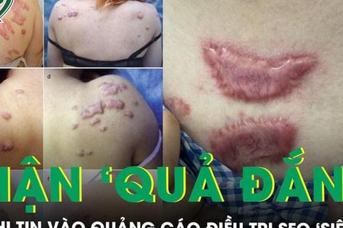 Chi 30 triệu trị sẹo 'siêu tốc', người phụ nữ nhận lại sẹo lồi như 'đỉa trâu'