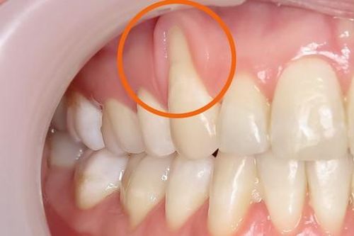 Tụt lợi có chữa được không?