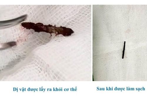 Người đàn ông bị đinh cắm sâu vào cổ 15 năm
