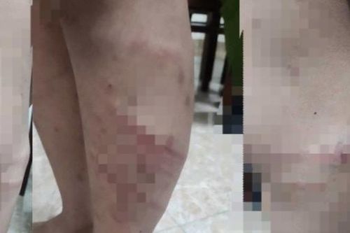 Giám đốc Công an Phú Thọ chỉ đạo điều tra vụ bé 11 tuổi bị mẹ và người tình đánh