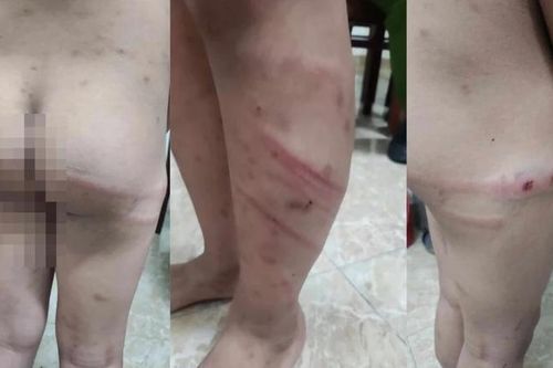 Khẩn trương điều tra, xử lý vụ bé 11 tuổi bị bạo hành dã man