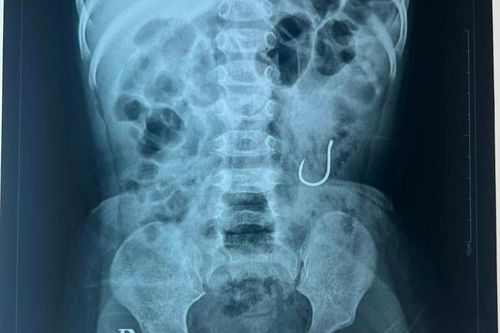 Đẩy thành công dị vật lưỡi câu ra khỏi cơ thể bệnh nhi 16 tháng tuổi