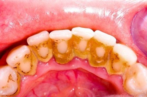 6 lý do khiến bạn phải lấy cao răng