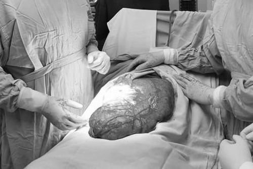 Nam thanh niên chủ quan tưởng béo bụng, bác sĩ mổ ra khối u 8kg, đường kính 40cm