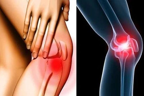 Việt Nam có tỷ lệ người mắc bệnh cơ xương khớp cao trên thế giới