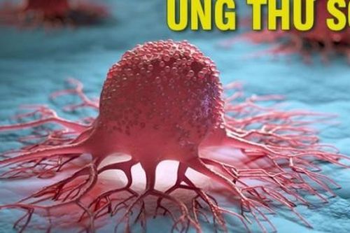 Những dấu hiệu cảnh báo ung thư sớm