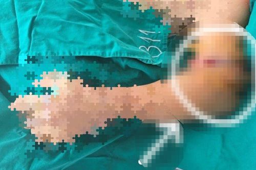 Nối cánh tay đứt rời cho người bệnh bị tai nạn lao động