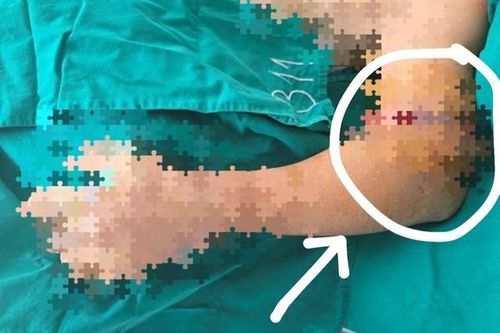 Nối thành công cánh tay bị đứt rời cho người đàn ông 44 tuổi bị tai nạn lao động