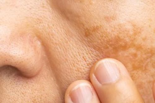 Các cách điều trị tăng sắc tố