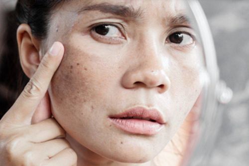 Mách bạn mẹo làm mờ vết đồi mồi trên da nhanh chóng