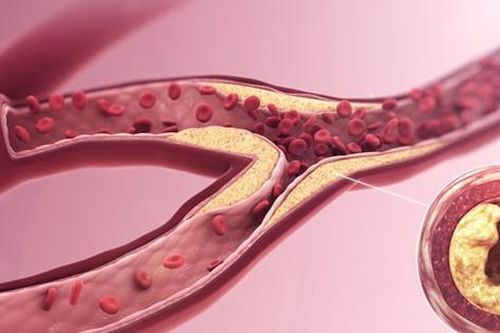 7 siêu thực phẩm mùa hè ngăn ngừa đột quỵ