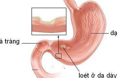 Viêm loét dạ dày có thành ung thư không?