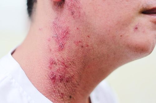 TPHCM: Hàng trăm người biến dạng da, nhập viện vì nhiễm độc kiến ba khoang