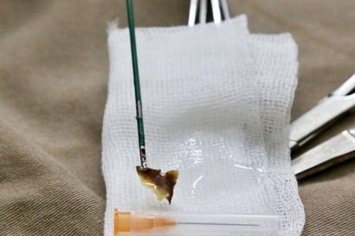 Mảnh xương nhọn 'mắc kẹt' trong phế quản bệnh nhân