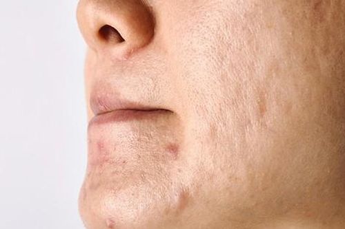 Sẹo rỗ có tự hết không?