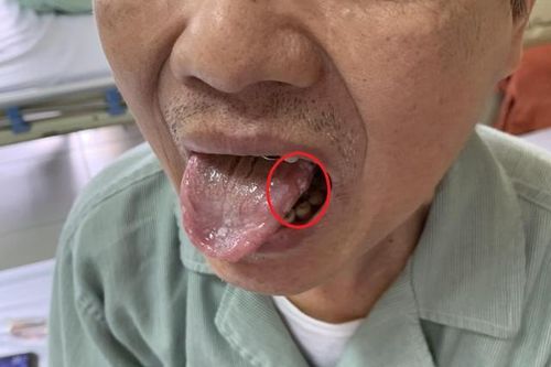 Ung thư khoang miệng: Nguyên nhân, triệu chứng, phòng ngừa và điều trị