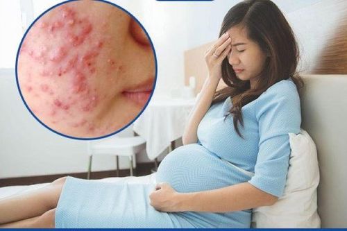 Khắc phục mụn trứng cá ở phụ nữ mang thai