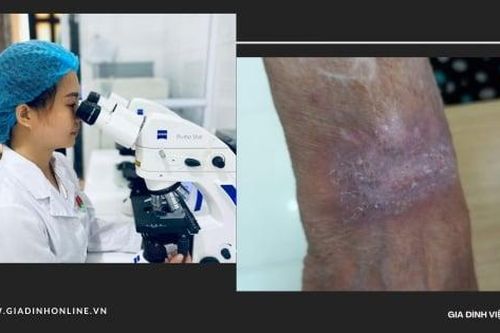 Phát hiện mắc lao da sau nhiều năm nổi mẩn ngứa ở cổ tay