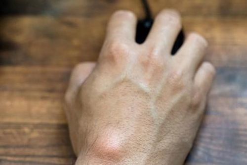 Cục u lồi lên trên cổ tay cảnh báo điều gì về sức khỏe của bạn? Có phải khối u ung thư không?