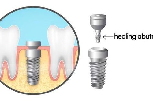 Trồng răng implant công nghệ mới: Tại sao phải sử dụng trụ lành thương giải phẫu cá nhân hóa?
