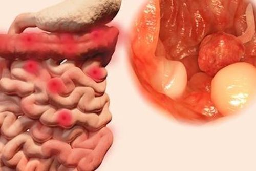 Nguyên nhân nào gây ra polyp đại tràng?