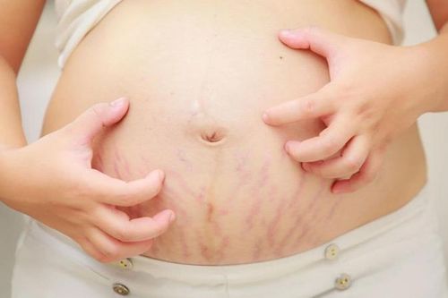 Cách đơn giản hạn chế rạn da khi mang thai