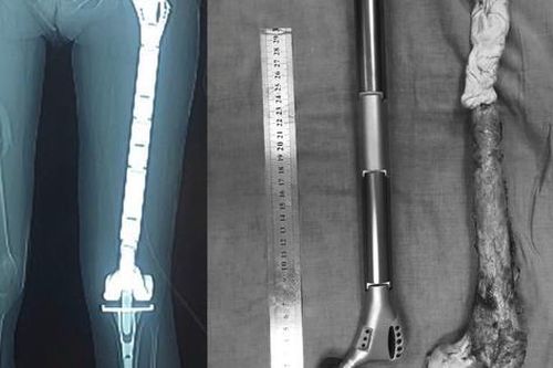Ung thư xương: Nguyên nhân, triệu chứng, phòng ngừa và điều trị