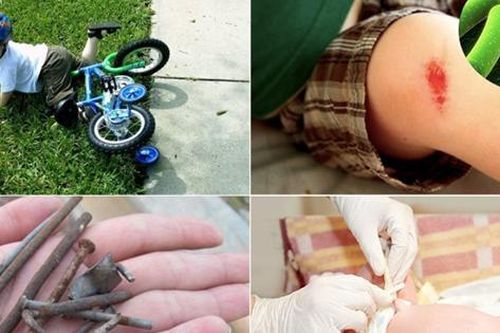 Uốn ván: Nguyên nhân, biểu hiện, cách điều trị và phòng bệnh