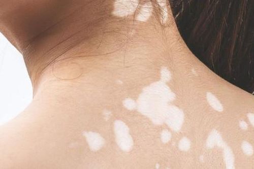 Bài tập làm chậm quá trình tiến triển của bệnh bạch biến