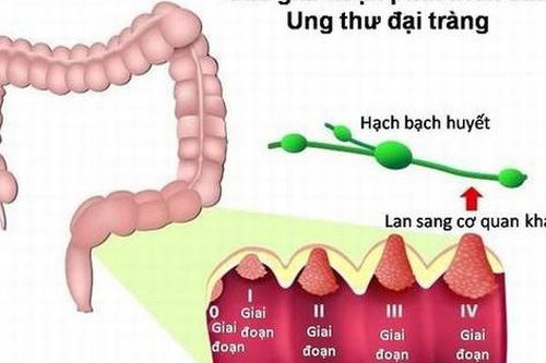 Ung thư đại tràng: Nguyên nhân, biểu hiện, cách điều trị và phòng bệnh