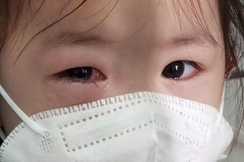 Làm gì khi bị đau mắt đỏ?