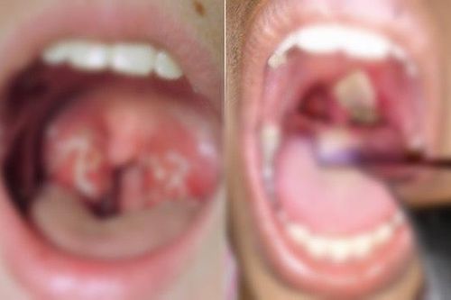 Bắc Giang khẩn trương xử lý ổ dịch bạch hầu sau khi nữ nhân viên quán karaoke mắc bệnh
